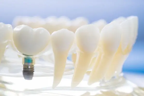 Implantes Dentários
